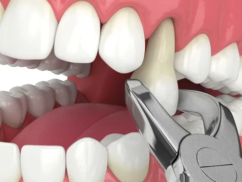When Should I Consider Tooth Extraction?